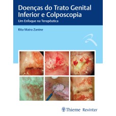 DOENÇAS DO TRATO GENITAL INFERIOR E COLPOSCOPIA: UM ENFOQUE NA TERAPÊUTICA