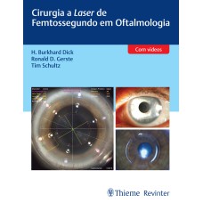 CIRURGIA A LASER DE FEMTOSSEGUNDO EM OFTALMOLOGIA