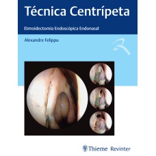 TÉCNICA CENTRÍPETA: ETMOIDECTOMIA ENDOSCÓPICA ENDONASAL