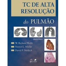 TC DE ALTA RESOLUÇÃO DO PULMÃO