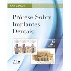 PRÓTESE SOBRE IMPLANTES DENTAIS