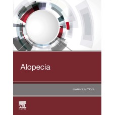 ALOPECIA