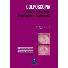 COLPOSCOPIA: TÉCNICA, INDICAÇÕES, DIAGNÓSTICO E TRATAMENTO