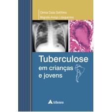 TUBERCULOSE EM CRIANÇAS E JOVENS