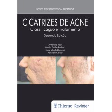 CICATRIZES DE ACNE: CLASSIFICAÇÃO E TRATAMENTO