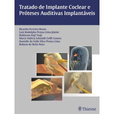 TRATADO DE IMPLANTE COCLEAR E PRÓTESES AUDITIVAS IMPLANTÁVEIS