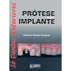 PRÓTESE SOBRE IMPLANTE - SÓ DENTES ANTERIORES