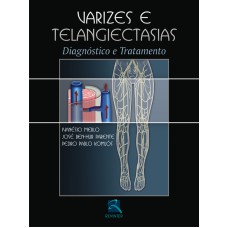 VARIZES E TELANGIECTASIAS - DIAGNÓSTICO E TRATAMENTO